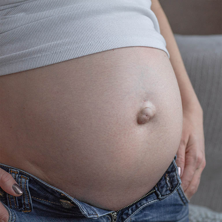 Hernia Umbilical y embarazo Centro de la hernia de Tijuana